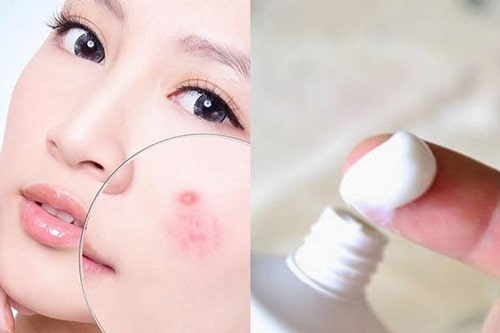 Trị mụn