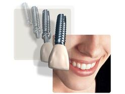 Cấy ghép Implant - Nha khoa Elite