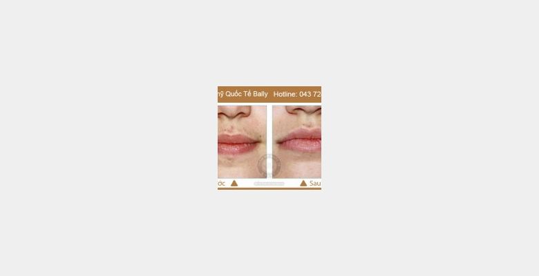 Thẩm Mỹ  Quốc Tế Bally - Hình 4